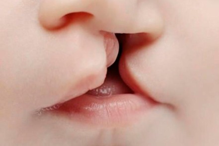 Labio leporino